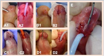 Urethral Plate Characteristics in Cases of Non-proximal Hypospadias May Not Be Associated With a Higher Risk of Complications When a Two-Stage Repair Is Applied